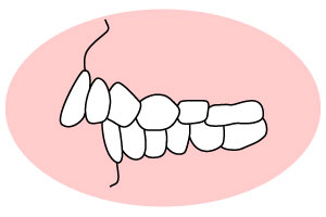 前歯または上顎全体が出ている～上顎前突・出っ歯～