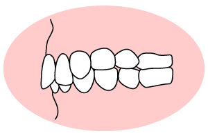 上の歯列が下の歯列を深く覆う～過蓋咬合～
